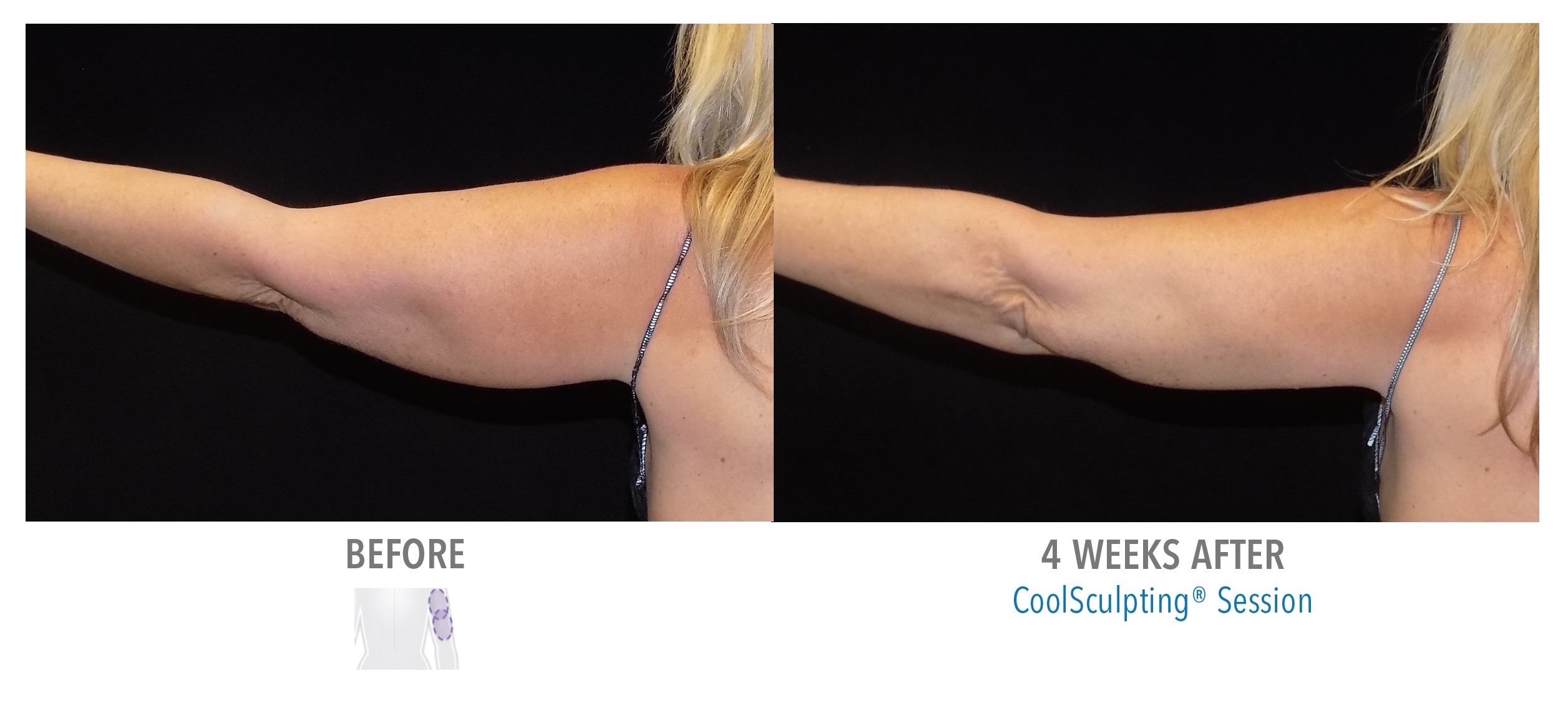 Arms | Coolsculpting | Cool Sculpting | Fat Removal | Erie PA.